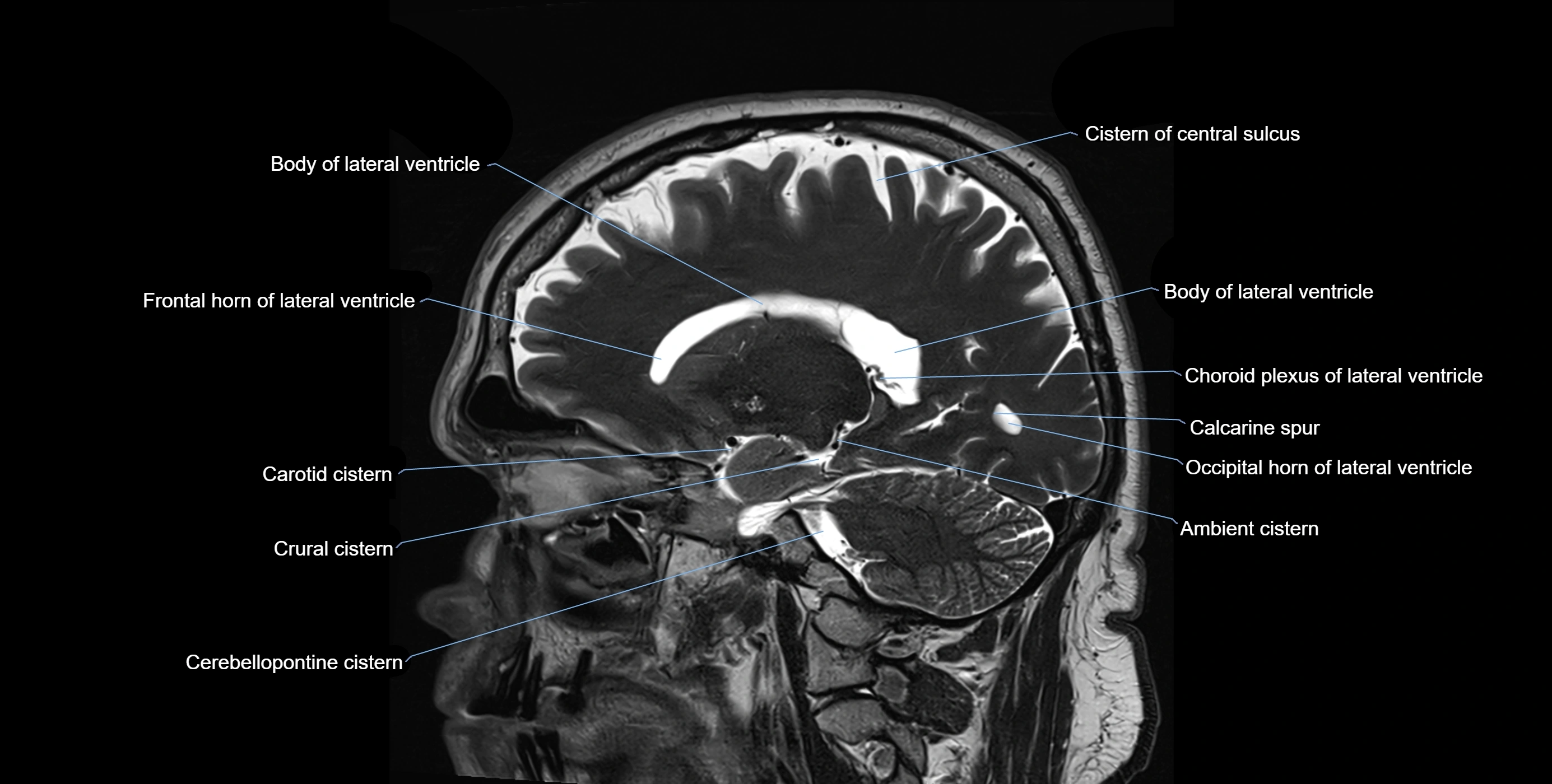 Brain cisterns  and ventricles sagittal anatomy 3T MRI image-img-00001-00021.webp